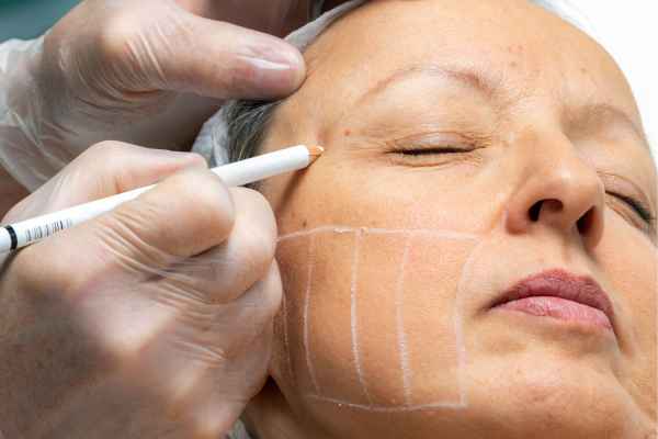 CryoPen: 5 Skin Concerns It May Be Used to Treat 4 What should you ask before having CryoPen treatment St Albans?
