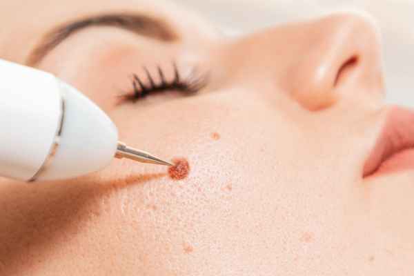 CryoPen: 5 Skin Concerns It May Be Used to Treat 3 What actually happens during a CryoPen treatment St Albans?