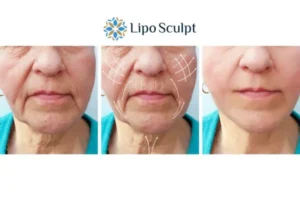 Explaining Morpheus8 And What It Can Do For You 3 Boost your confidence with Morpheus8 St Albans call our team today!