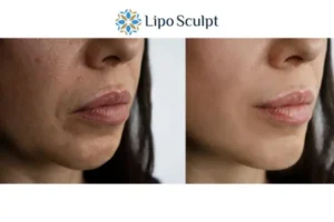 Explaining Morpheus8 And What It Can Do For You 4 Morpheus8 St Albans the best results - call our team today!