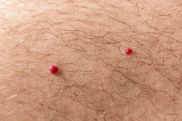 CryoPen: 5 Skin Concerns It May Be Used to Treat 2 cherry angioma removal St Albans