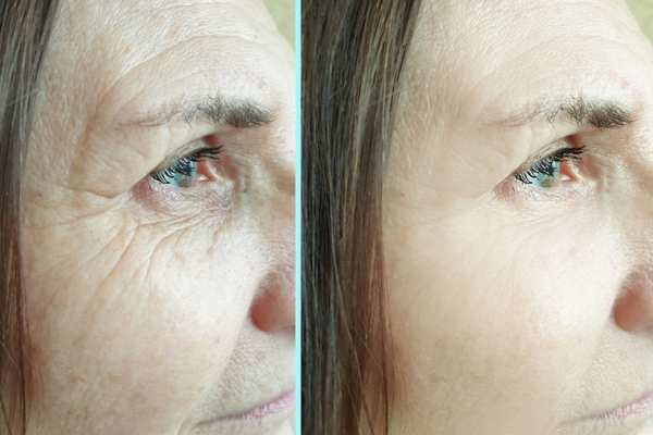 Why Do People Choose HIFU for a Non-Surgical Facelift? 4 How long can HIFU results last St Albans?