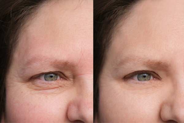 HIFU vs Botulinum Toxin: Understanding the Differences 4 How long do HIFU results last St Albans?