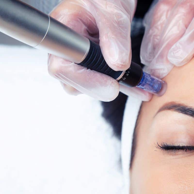 Morpheus8 treatment St Albans from Lipo Sculpt - Book in today!