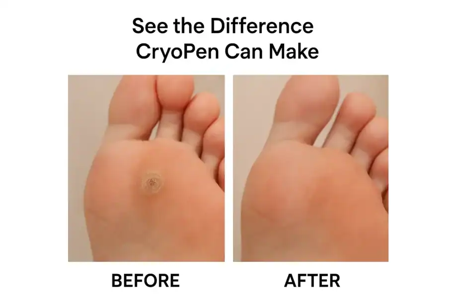CryoPen Verruca Treatment: What to Expect Before, During and After Treatment 3 Before and after Cryopen