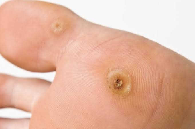 CryoPen Verruca Treatment: What to Expect Before, During and After Treatment 2 What happens during CryoPen verruca removal?