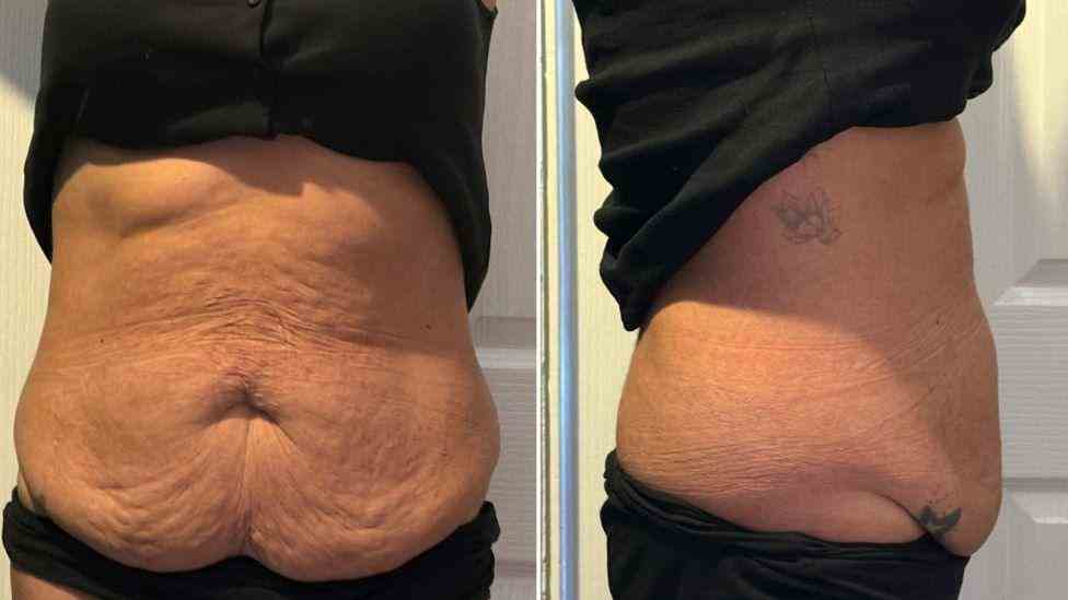 Lost the Weight but Not the Loose Skin? What You Should Know 1 Is It Definitely Loose Skin St Albans?