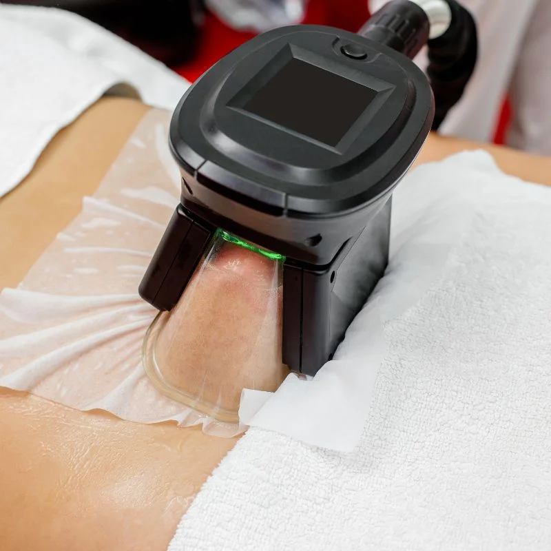 Fat Freezing treatment St Albans